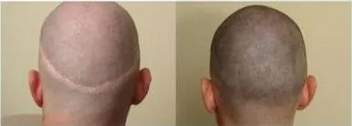 Hair Transplant Cost in Dubai photo 2