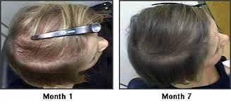 Hair Transplant Cost in Dubai photo 3