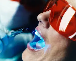 Advance Teeth Whitening photo 4
